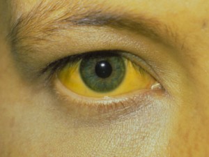 Pasak specialistų, į gydytojus hepatitu A užsikrėtęs žmonės dažniausiai kreipiasi tik tuomet, kai pradeda ryškėti gelta: oda ir akių gleivinė tampa gelsvos spalvos. Hepatitu A užsikrėtė valgydama šaldytas uogas
