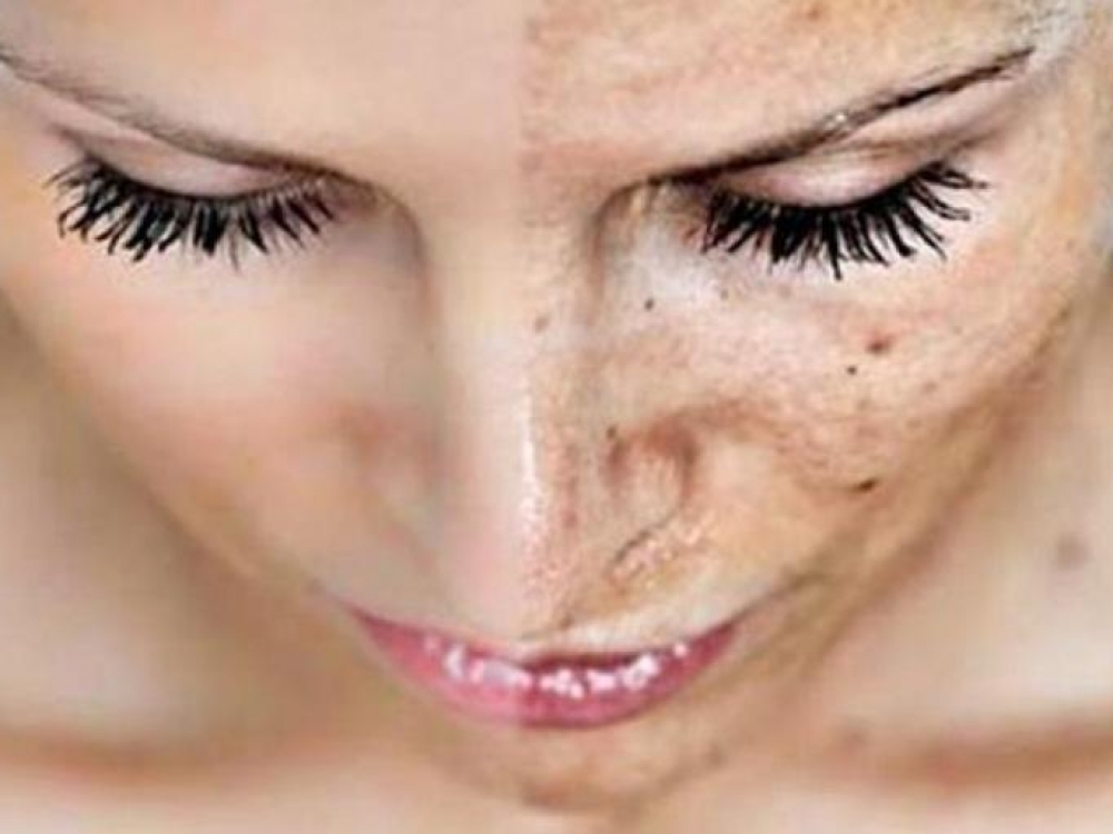 Odos pigmentacijai būdinga rudos, nelygios, saulės arba amžinės pigmentinės dėmės, taip pat odos elastingumo sumažėjimas ir padidėjęs raukšlėtumas, atsirandantis odą ilgą laiką veikiant ultravioletiniams spinduliams. 