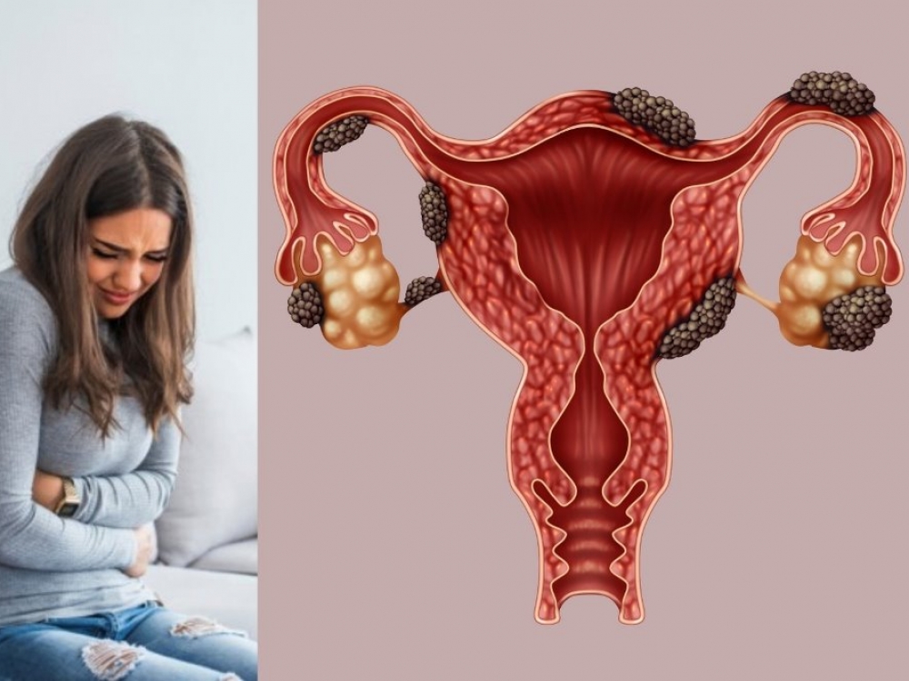 Endometriozė yra dažnai pasireiškianti liga, ja serga kas dešimta bendrosios populiacijos reprodukcinio amžiaus moteris.