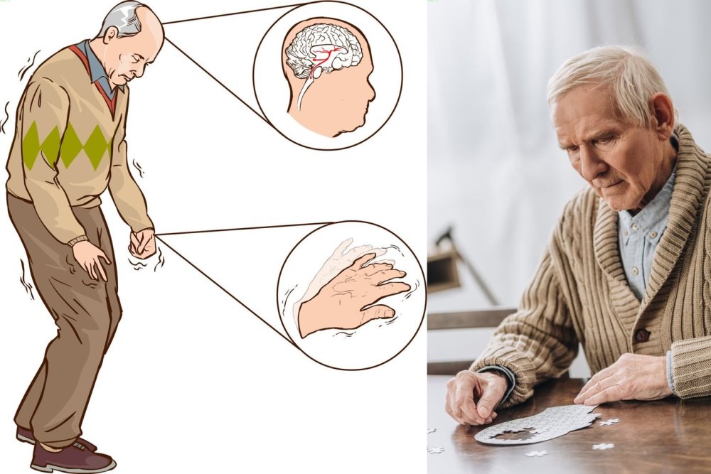 Drebėjimą patiria ne visi asmenys, kuriems diagnozuojama Parkinsono liga, bet visiems ligoniams būdingas judesių ar mąstymo, kalbos sulėtėjimas, raumenų sustingimas, eisenos pasikeitimas.