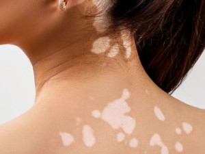 Po nudegimo saulėje – baltos dėmės ant odos