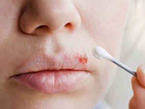 Greitesnį pūslelinės gydymą lemia du veiksniai: jos pastebėjimas laiku ir veikimas nedelsiant.