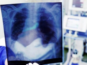 Tuberkuliozė: gyvenimas ligoninėje