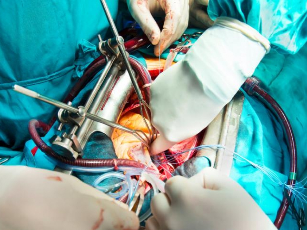 Vainikinių širdies arterijų šuntavimas – atviros chirurgijos operacija (atveriama krūtinės ląsta). Jos metu chirurgas paima dalį sveikos kraujagyslės iš jūsų kojos, krūtinės arba rankos. Tuomet paimta kraujagyslė prijungiama (persodinama) prie vainikinės širdies arterijos truputį žemiau užsikimšimo vietos. Taip sukuriamas naujas „aplinkelis“ kraujui tekėti.