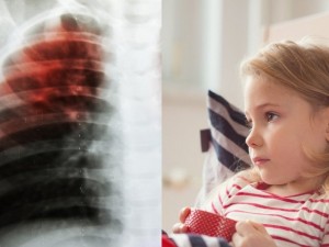 Vaikų infekcijos šaltinis – suaugusieji, sergantys aktyvia atvira tuberkuliozės forma, t. y. išskiriantys tuberkuliozės mikobakterijas. Kosėdami, čiaudėdami ir kalbėdami jie bakterijas paskleidžia aplinkui, o šalia esantys gali jas įkvėpti ir užsikrėsti.