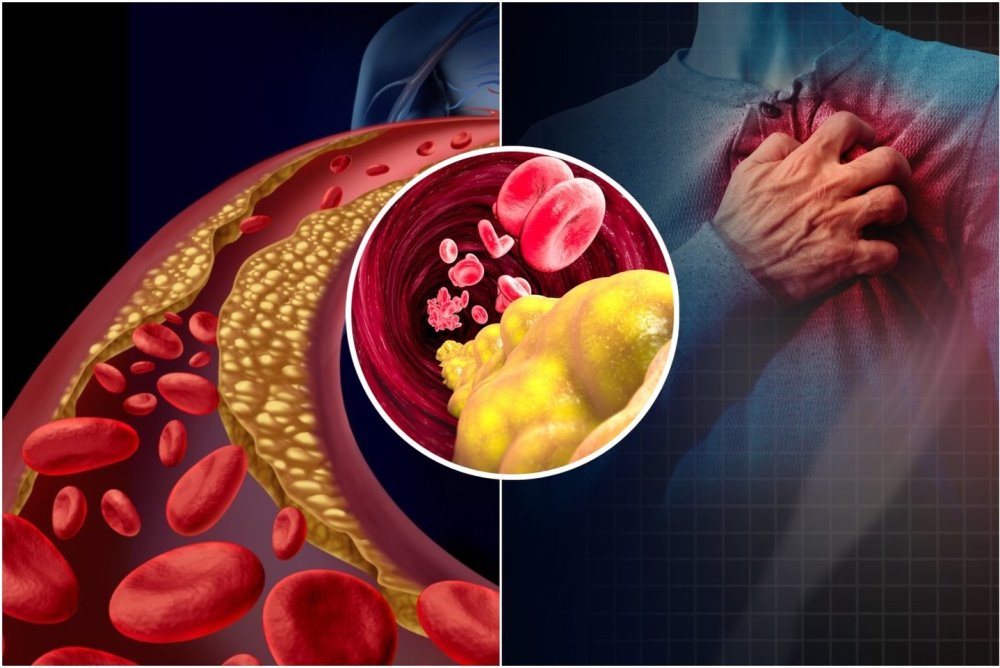 Išeminę širdies ligą dažniausiai sukelia rizikos veiksnių visuma. Tai yra antsvoris, nutukimas, rūkymas, cukrinis diabetas, padidėjęs kraujo spaudimas, cholesterolio koncentracijos padidėjimas kraujyje, mažas fizinis aktyvumas bei stresas.