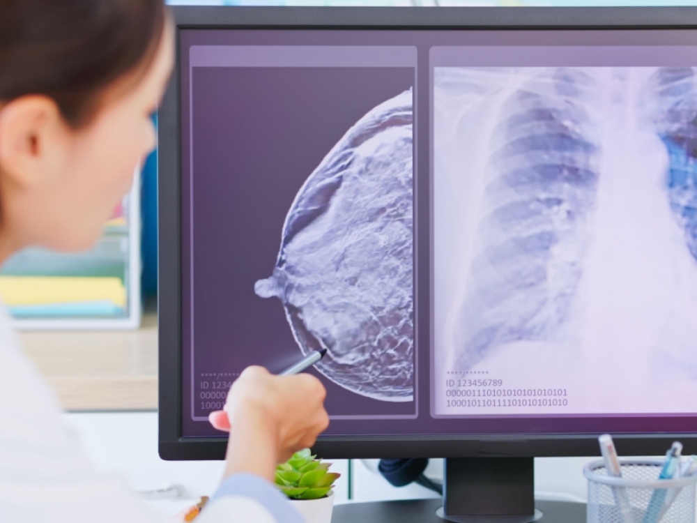 Krūties vėžio gydymas eksperimentiniu „AstraZeneca“ vaistu „Camizestrant“ ankstyvojo tyrimo etape sumažino ligos progresavimo arba mirties riziką perpus, kas, ekspertų teigimu, gali pakeisti įprastinę gydymo praktiką.