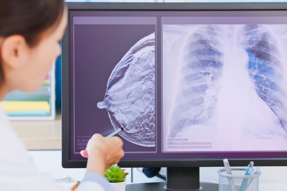 Krūties vėžio gydymas eksperimentiniu „AstraZeneca“ vaistu „Camizestrant“ ankstyvojo tyrimo etape sumažino ligos progresavimo arba mirties riziką perpus, kas, ekspertų teigimu, gali pakeisti įprastinę gydymo praktiką.