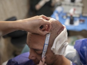 Pigios plaukų transplantacijos Turkijoje kasmet privilioja tūkstančius europiečių, tarp jų ir lietuvių, kurie vėliau slapčia ieško pagalbos gimtinėje.