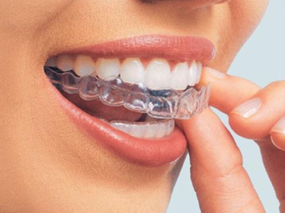 Nors sakoma, kad dantų balinimas – viena pigesnių odotologinių procedūrų, ne visi norėdami padailinti šypseną skuba į odontologo kabinetą. Verčiau ieško liaudiškų būdų, kurie gali ne tik neatnešti norimo rezultato, bet ir pakenkti.