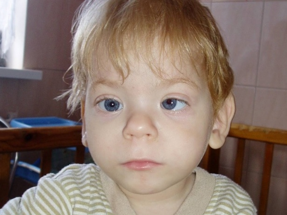Синдром фас у детей фото