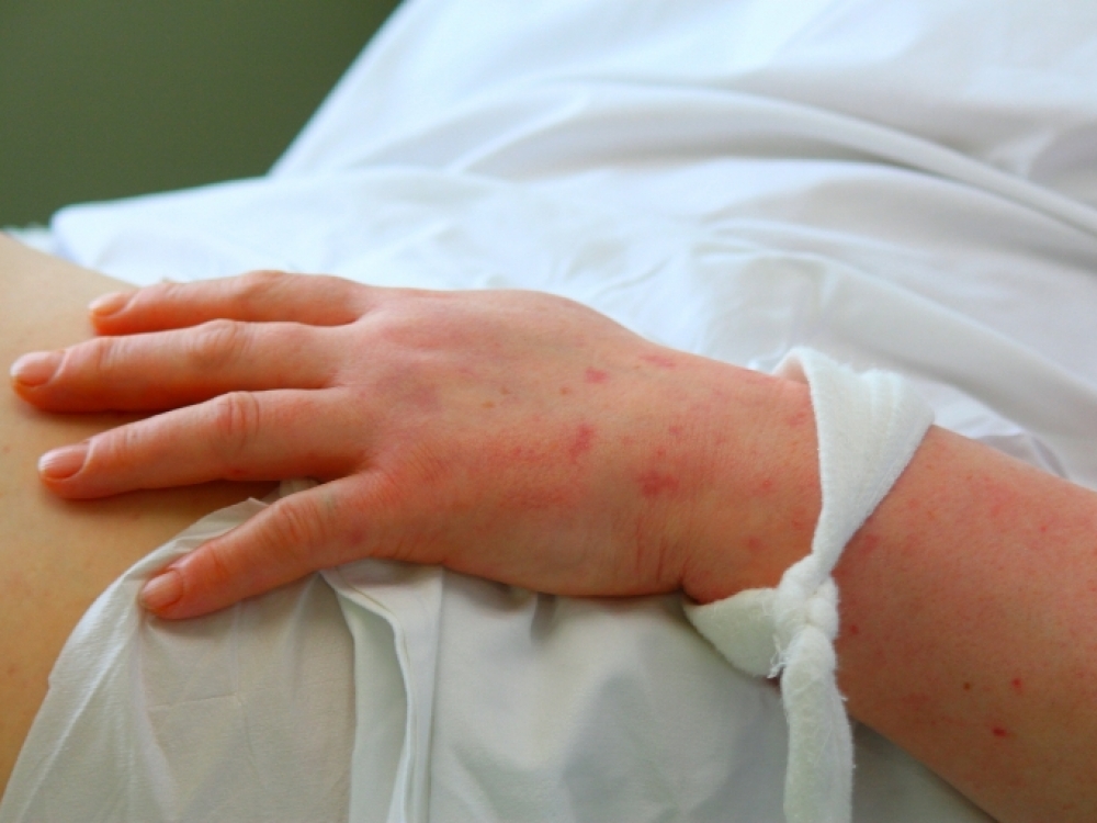 Lietuvos užkrečiamų ligų ir AIDS centro duomenimis, praėjusiais metais šalyje buvo diagnozuoti 76 susirgimai meningokokine infekcija (8 atvejais nustatyta letali baigtis).