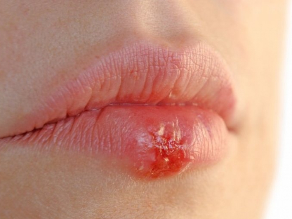 Herpes virusas dažniausiai pasireiškia lūpų, smakro srityse, vaikams dažnai ir šalia nosies landų.