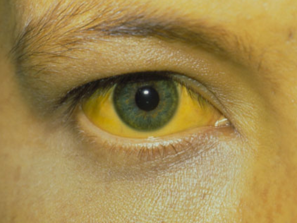 Pasak specialistų, į gydytojus hepatitu A užsikrėtęs žmonės dažniausiai kreipiasi tik tuomet, kai pradeda ryškėti gelta: oda ir akių gleivinė tampa gelsvos spalvos.